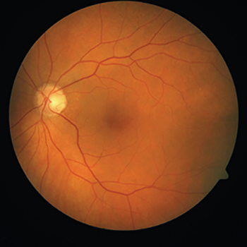 view of a retina
