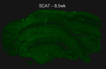 cells in cerebellum lose their stripes from spinocerebellar ataxia