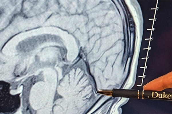 Pointer pointing at a particular area of a brain on a bran scan