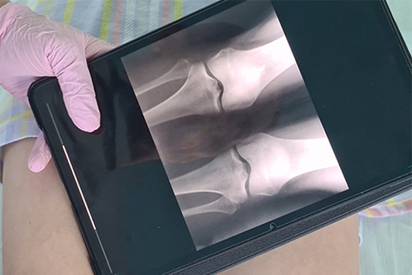 X-ray image of two knee joints on a handheld device.