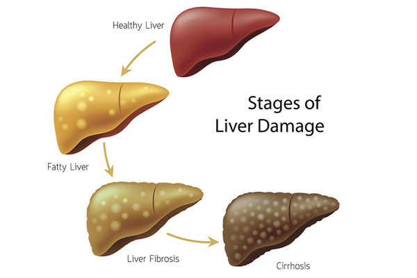 stages of liver damage