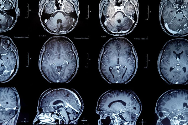 MRI showing a brain tumor