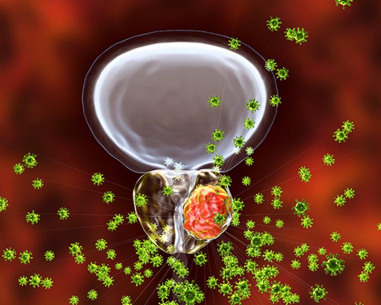 A microscopic image of prostate cancer cells