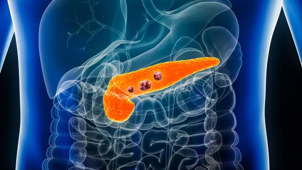 A graphic illustration highlights the pancreas