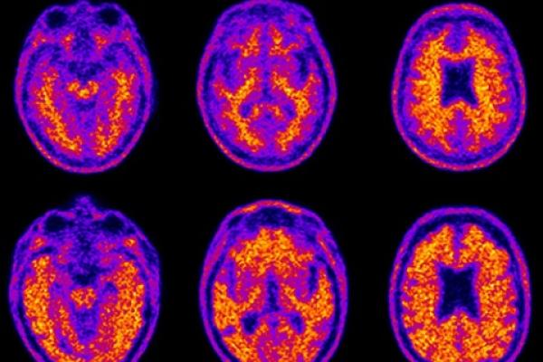 Scans of two study participants show the brain of a cognitively healthy 74-year-old (top row) who demonstrated average financial skills compared to an 86-year-old with mild Alzheimer's disease (bottom row) who demonstrated impaired financial skills. The bottom scan is positive for amyloid plaques, highlighted in yellow and orange throughout the brain and extending to its edges.