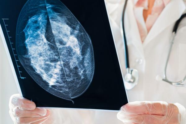mammogram film held in a physician's hands