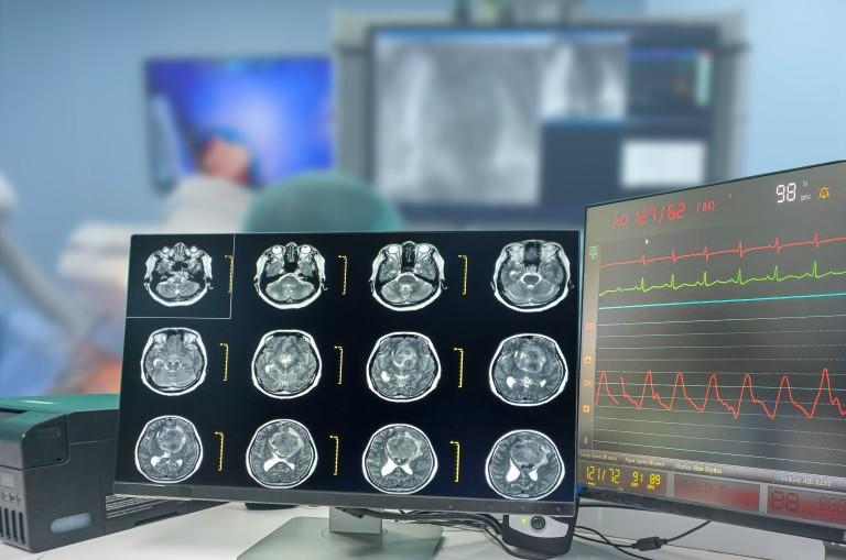 Computer monitor showing multiple images of a brain scan