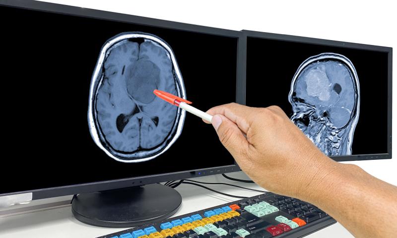 Hand pointing to a brain scan on a computer screen