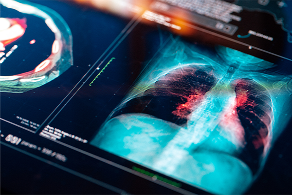 X-ray slide of lungs