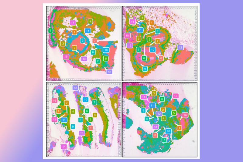 4 slices of lung tissue showing different areas of granulomas