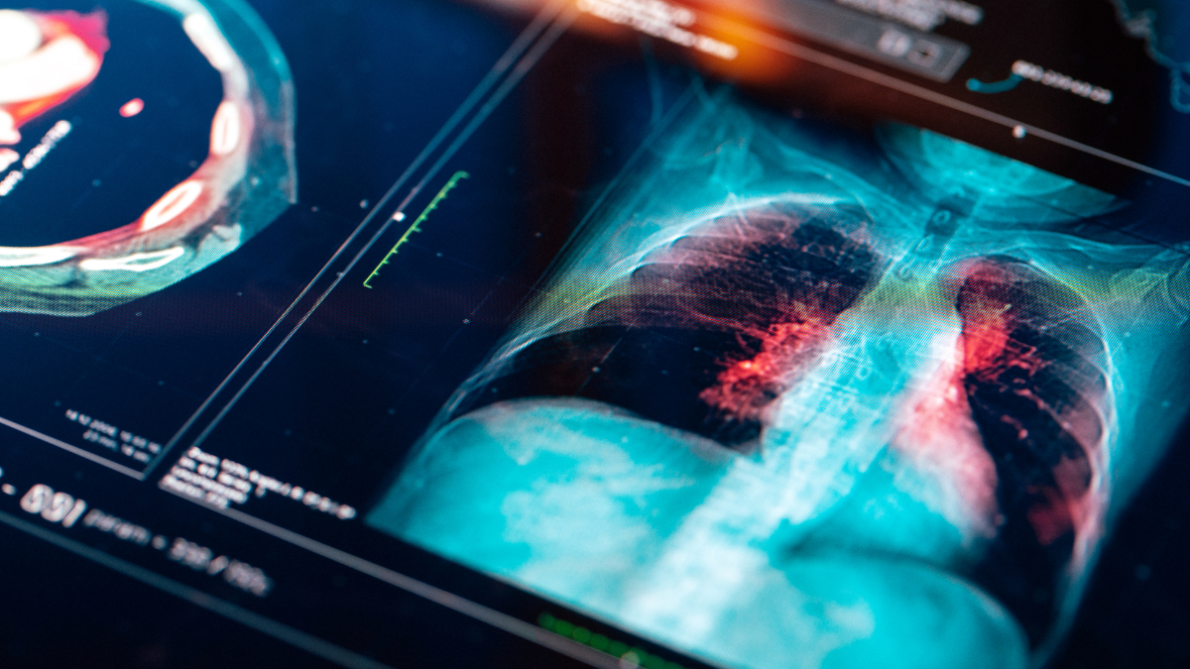 Chest X-ray. iStock photo