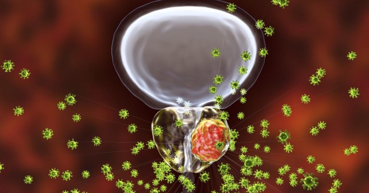 Early Prostate Cancers Can Harbor Aggressive Tumor Cells | Duke ...