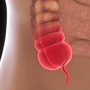 an inflamed appendix in the body cavity.