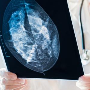 mammogram film held in a physician's hands