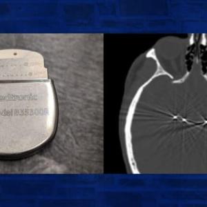 Deep Brain stimulator and visualization of it working in a brain