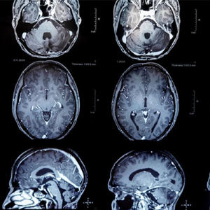 MRI showing a brain tumor