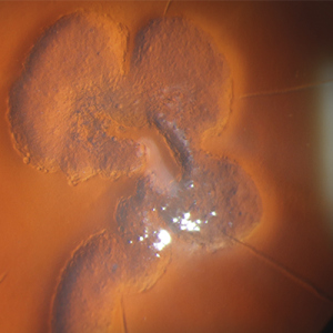 photo of epithelial ingrowth in the human eye