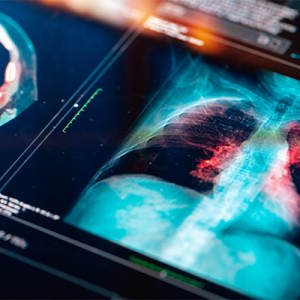 X-ray slide of lungs