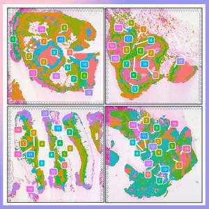 4 slices of lung tissue showing different areas of granulomas